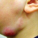 Lymphadenitis as a result of dental work using contaminated dental unit waterlines.