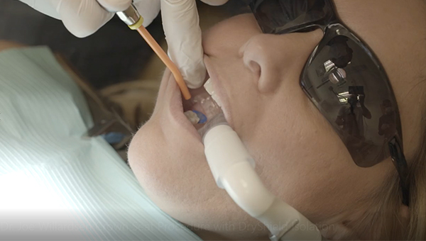 Sealing a crown with dryshield